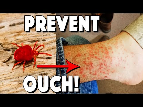 What Are Chiggers, How To Treat Bites, And How To Prevent!