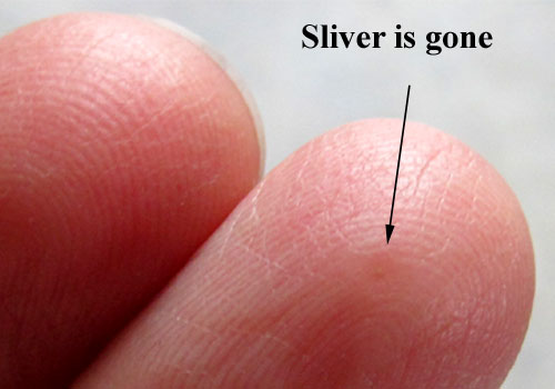 the easiest way to remove a sliver ~The Homesteading Hippy
