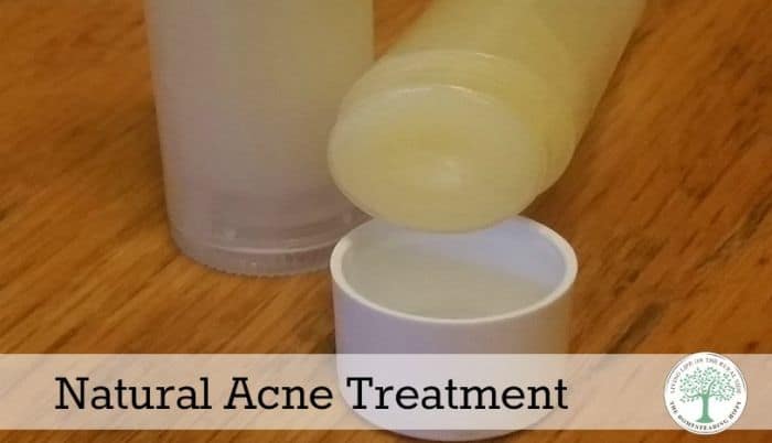acne treatment post