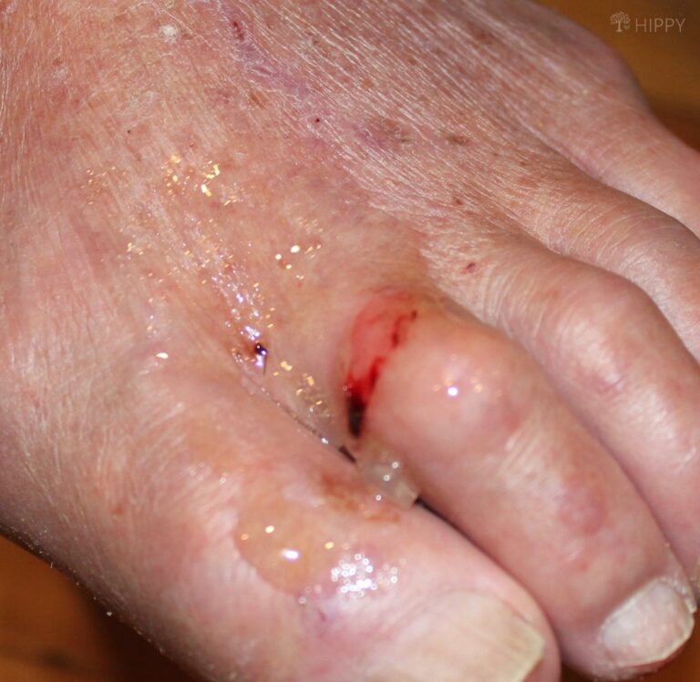 aloe gel on lacerated toe